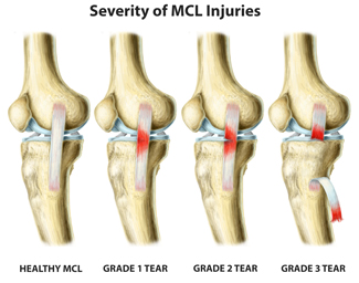icd 10 code for left mcl strain