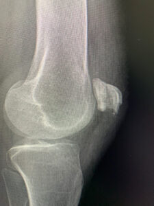 x-ray of patellar ligament fracture