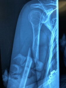 fracture of the right humerus