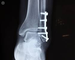 broken ankle
