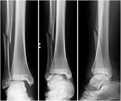 fibular fracture